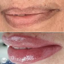 Lips - Corrective