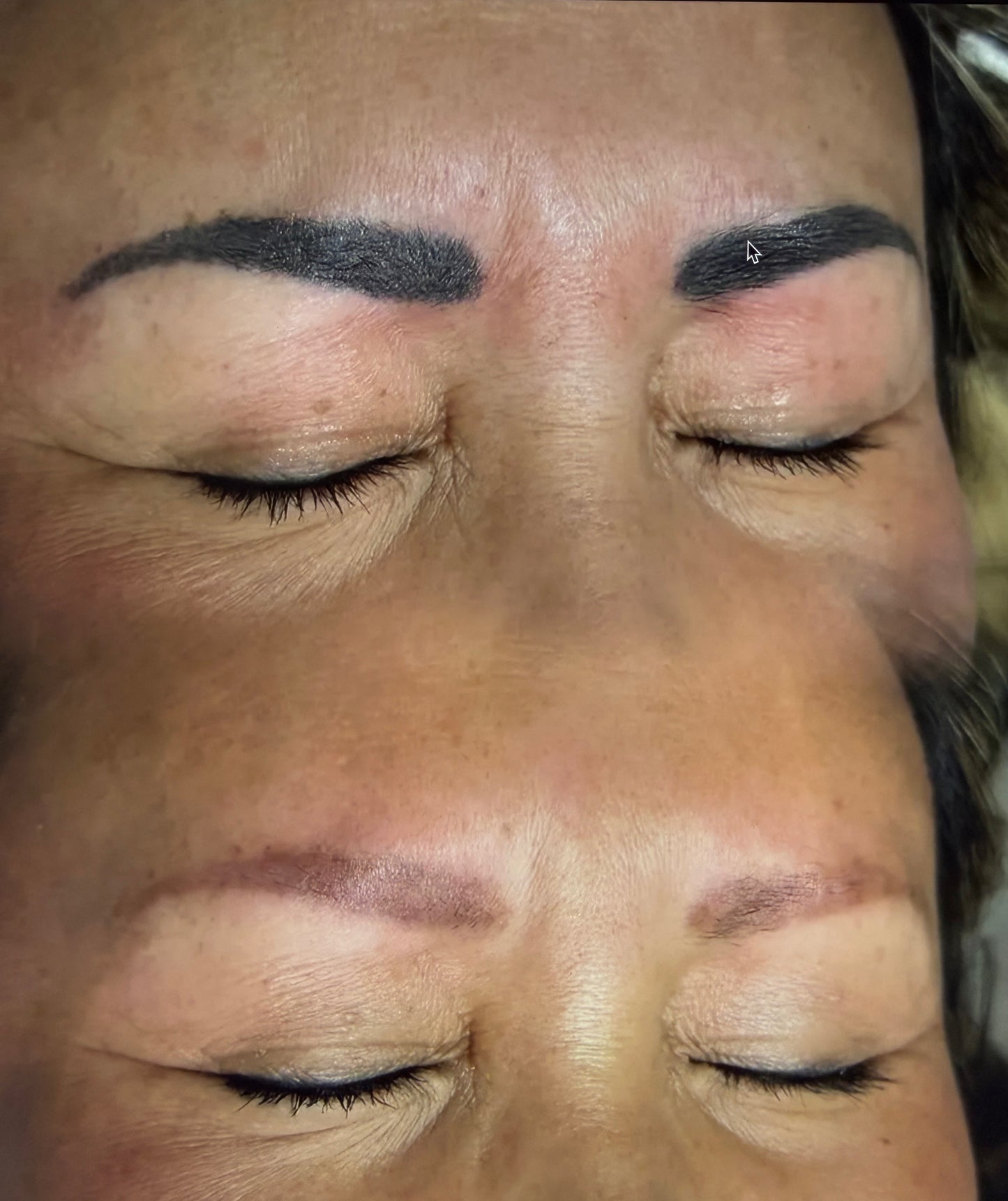 Eyebrow Tattoo Removal