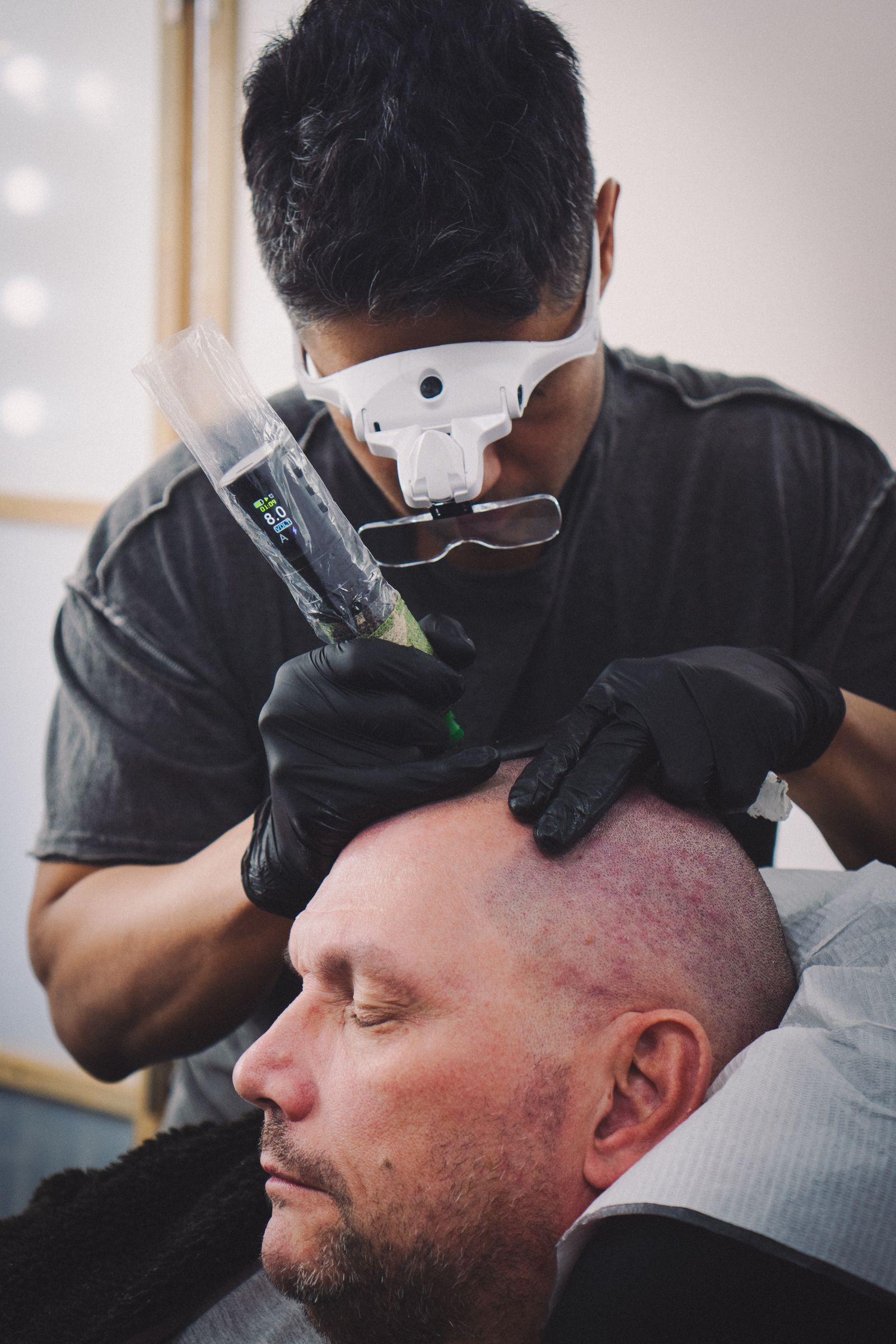 Scalp Micropigmentation at Shihan Beauty Clinic