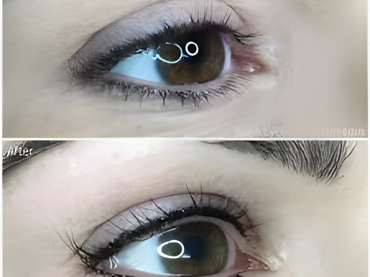 Lash Line Enhancement (Invisible Eyeliner) at Shihan Beauty Clinic