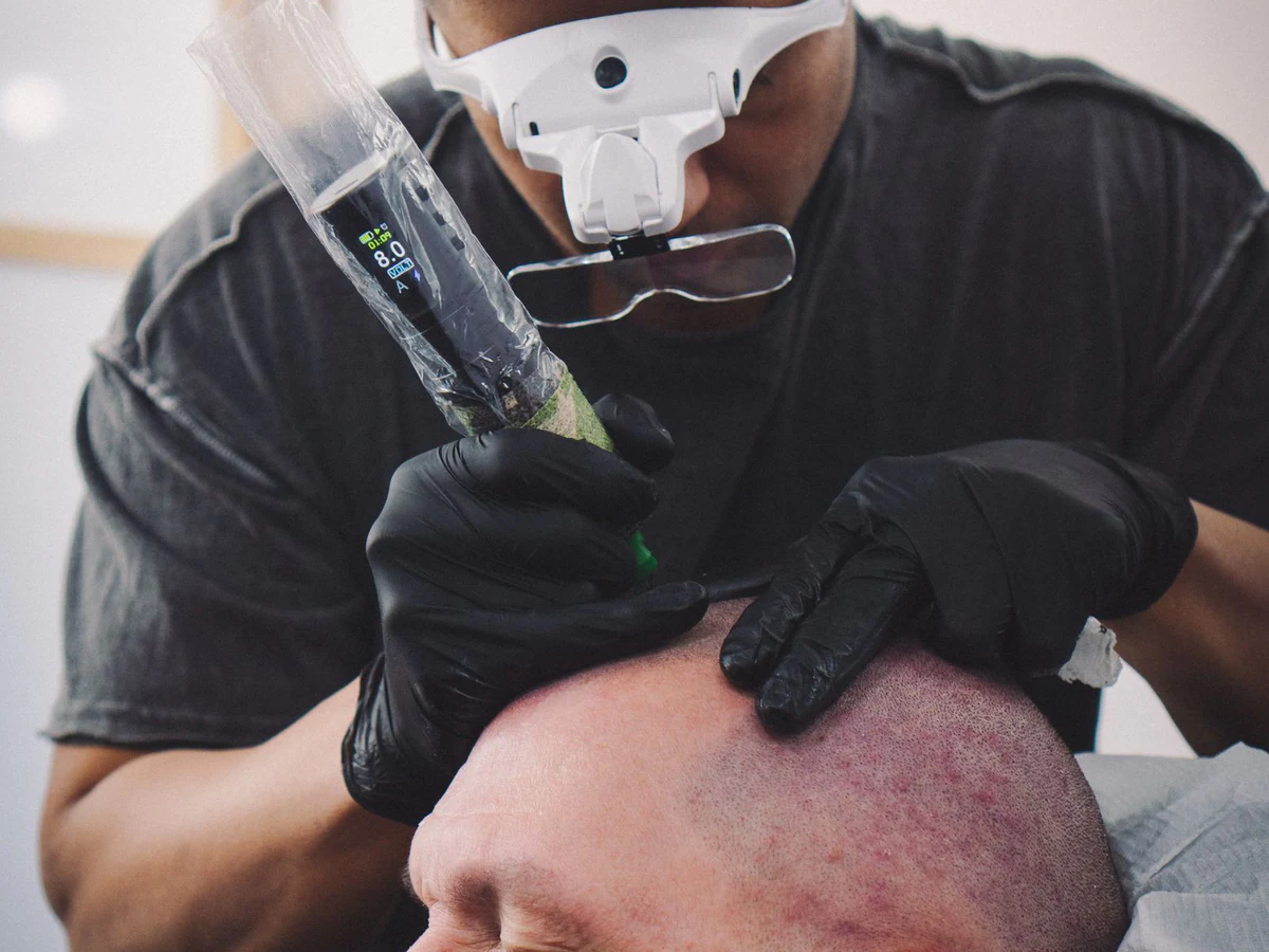 Scalp Micropigmentation (SMP) at Shihan Beauty Clinic