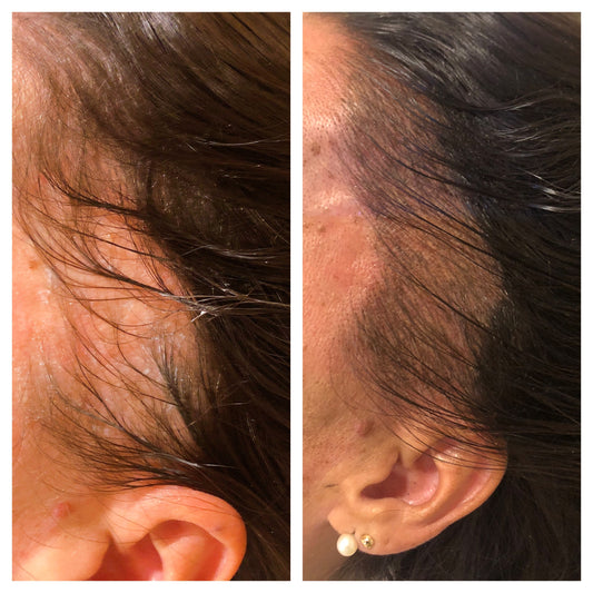 Scalp Micropigmentation